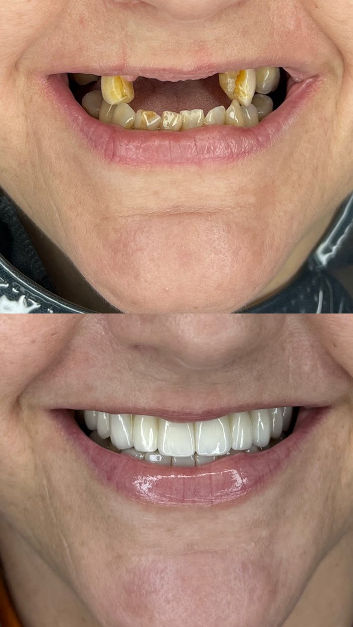 Antes e depois: Espaço nos dentes da frente