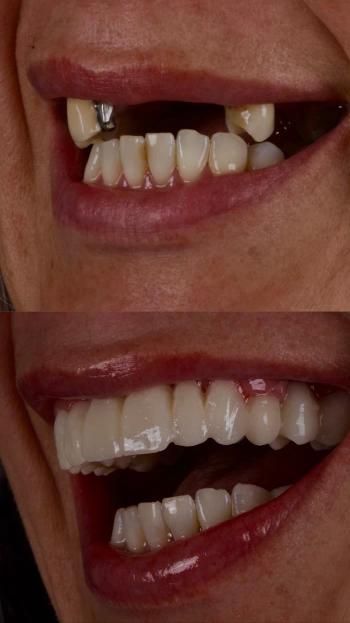 Antes e depois: Espaço lateral