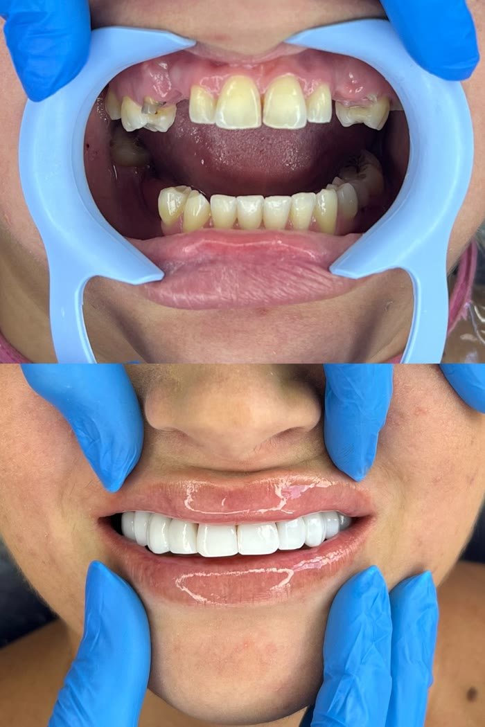 Antes e depois: Reabilitação anterior completa
